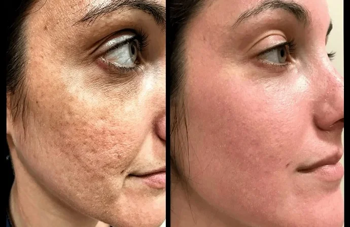 Acne Scar Treatment before and after