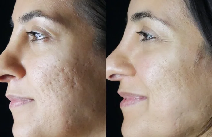 Acne Scar Treatment before and after
