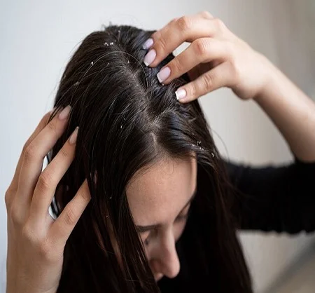 Dandruff Treatment in Dubai