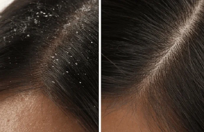 Dandruff Treatment before and after
