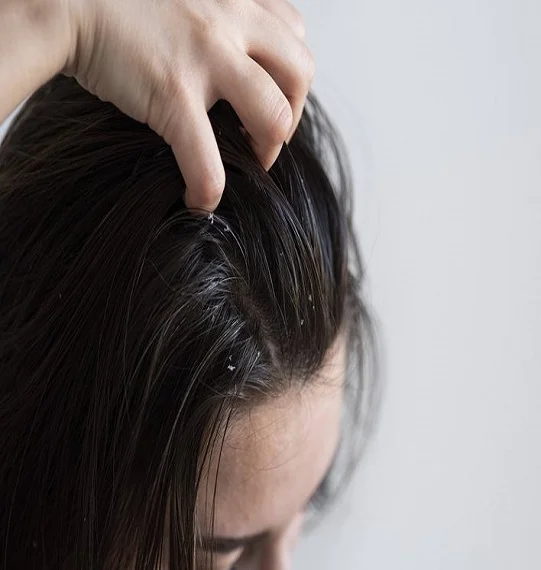 Dandruff Treatment in Dubai
