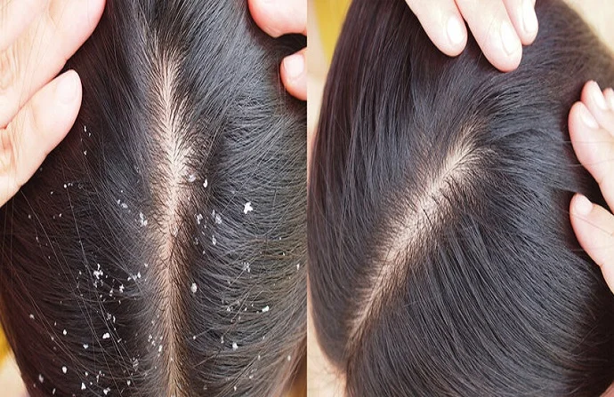 Dandruff Treatment before and after