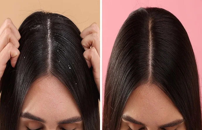 Dandruff Treatment before and after