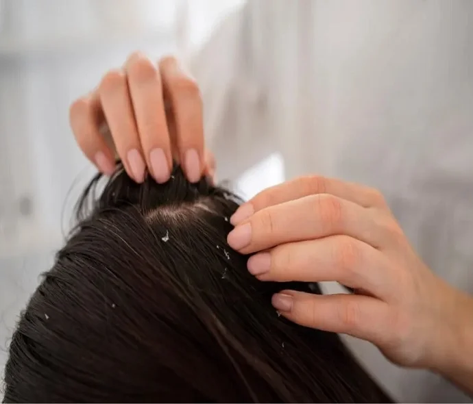 Dandruff Treatment in Dubai