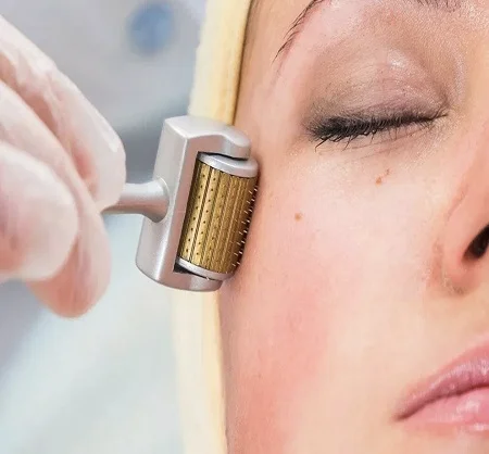 Derma Roller Treatment in Dubai