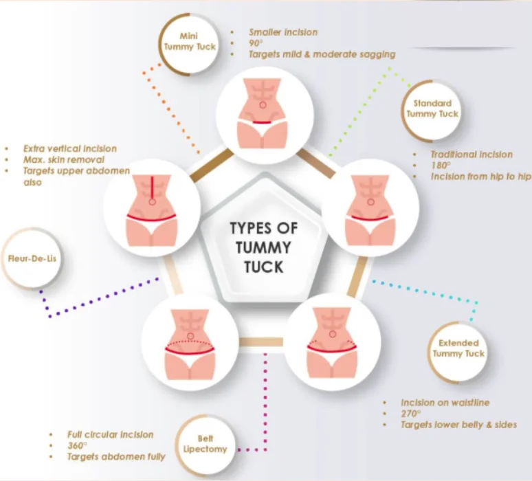 Different Types of Tummy Tuck