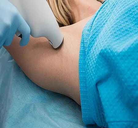 Hyperhydrosis Treatment in Dubai