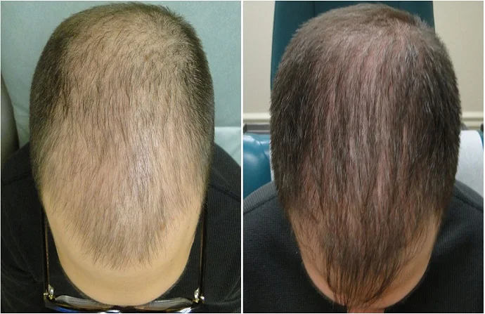 ACell PRP Treatment for Hair before and after