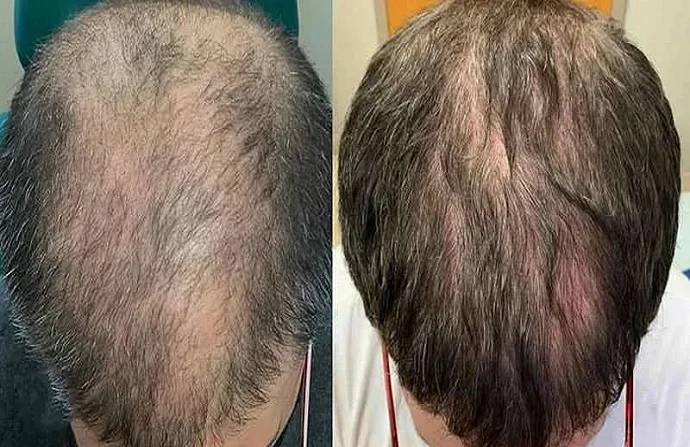 ACell PRP Treatment for Hair before and after