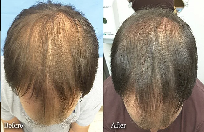 ACell PRP Treatment for Hair before and after