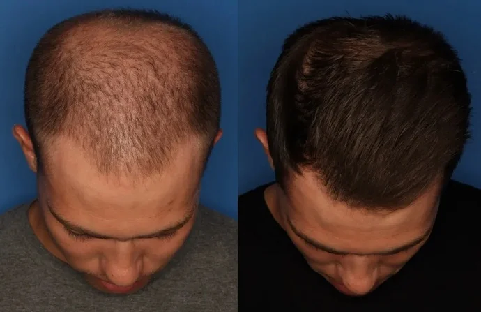 ACell PRP Treatment for Hair before and after