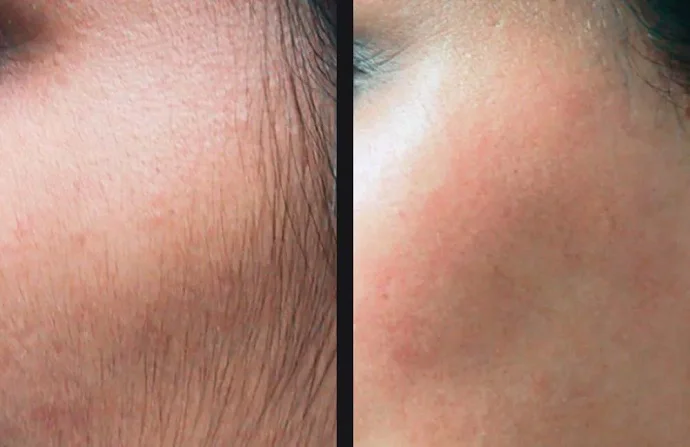 Laser Hair Lightening Session before and after