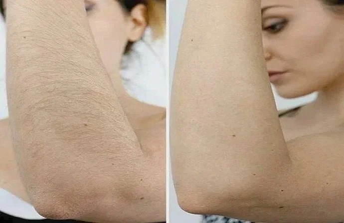 Laser Hair Lightening Session before and after