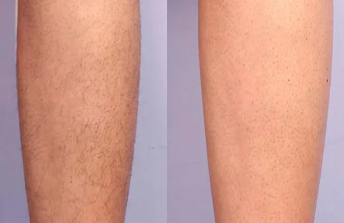 Laser Hair Lightening Session before and after