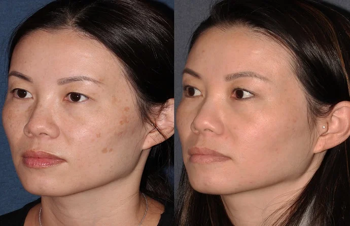 Skin Disease Treatment before and after