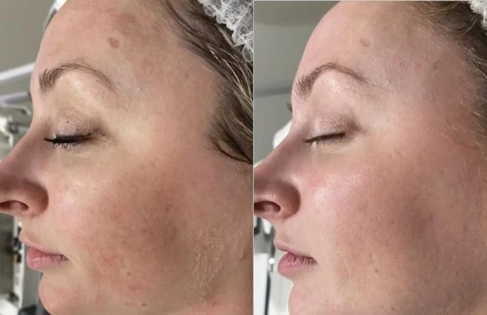 Spectra Laser Carbon Peeling before and after