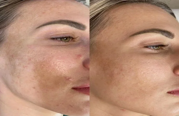 Spectra Laser Carbon Peeling before and after