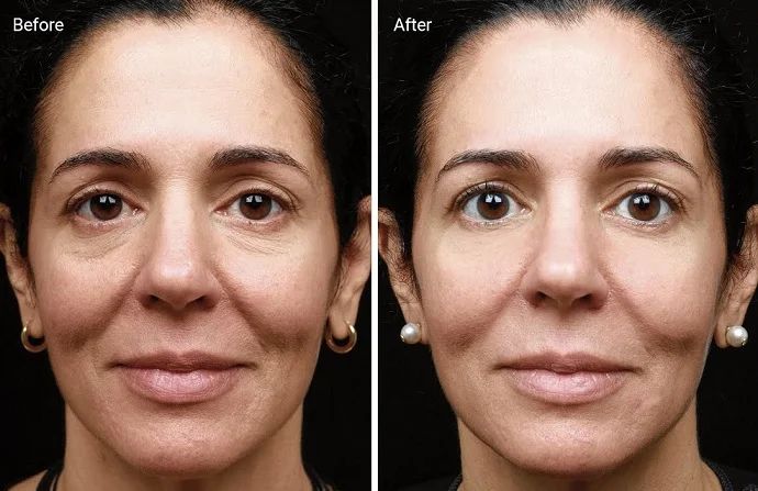 Anti-Aging Treatment before and after