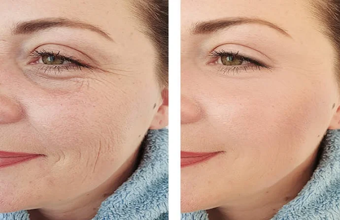 Anti-Aging Treatment before and after