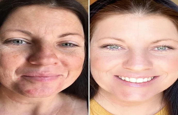 Anti-Aging Treatment before and after