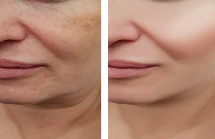 Aquagold Injection before and after