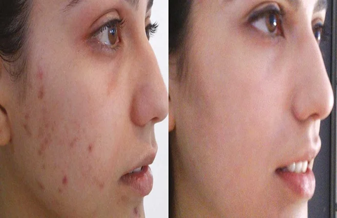 Best Dermartologist for Acne Treatment in Dubai