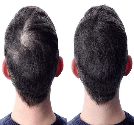 Crown Hair Transplant in Dubai