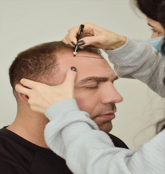 Crown Hair Transplant in Dubai