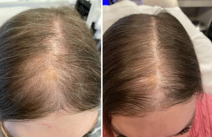 Crown Hair Transplant in Dubai before after