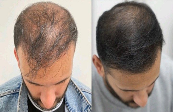 Crown Hair Transplant in Dubai before after