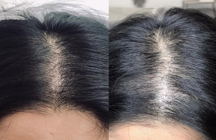 Crown Hair Transplant in Dubai before after