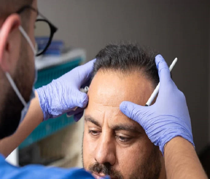 FUSS hair transplant in Dubai