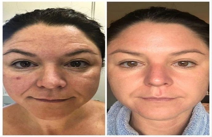 Facial Rejuvenation in Dubai before after