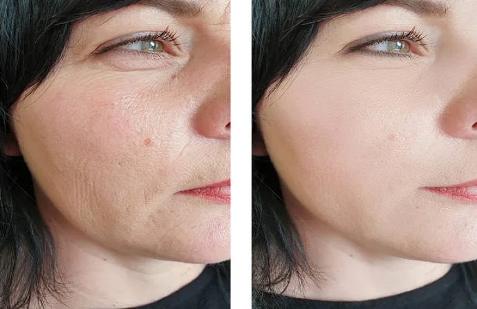 Fractional RF Microneedling before and after