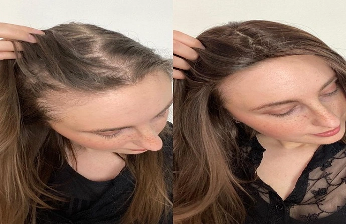 Hair Fillers in Dubai before after