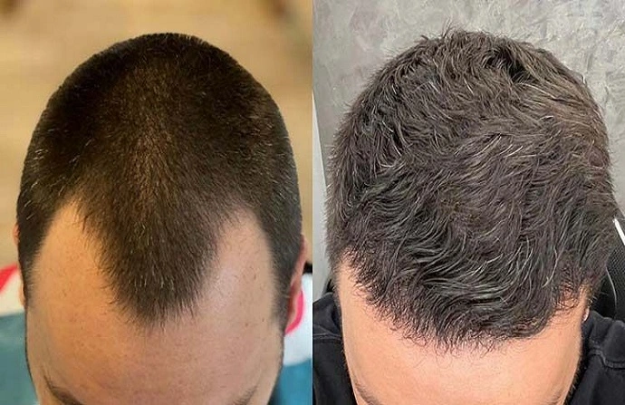 Hair Fillers in Dubai before after