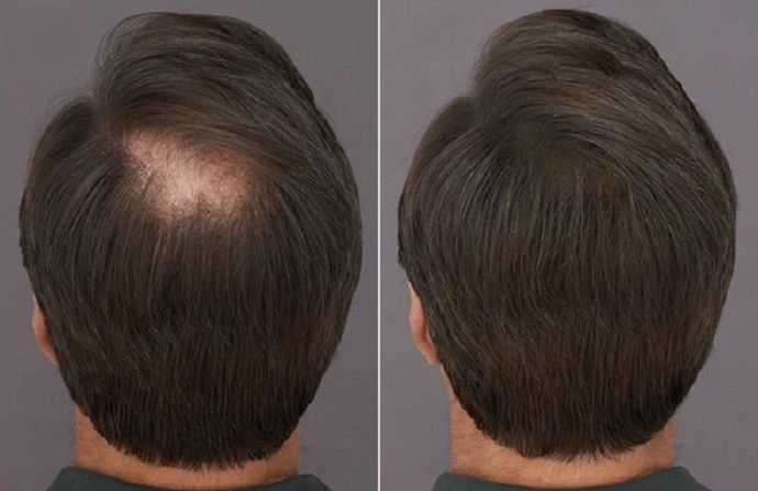 Hair Fillers in Dubai before after