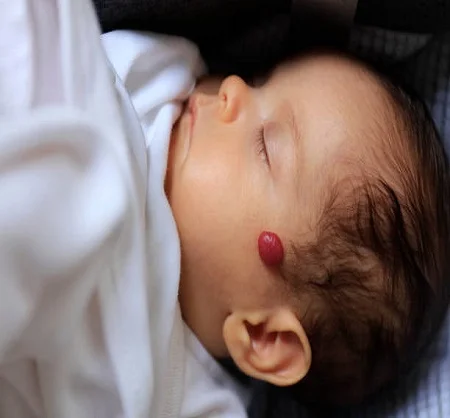 Hemangioma Treatment in Dubai