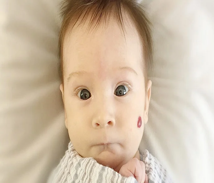 Hemangioma Treatment in Dubai