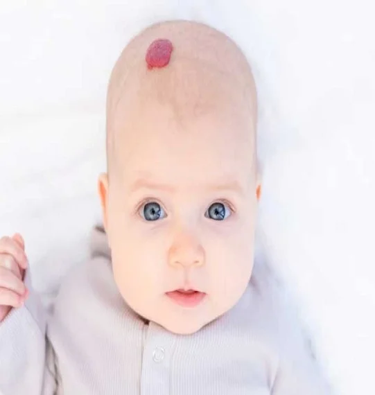 Hemangioma Treatment in Dubai