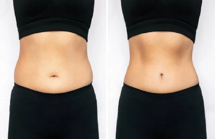 Liposonix Fat Removal before and after