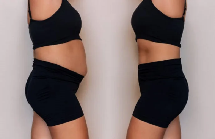 Liposonix Fat Removal before and after
