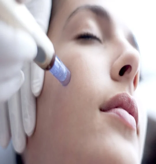 Microneedling Treatment in Dubai