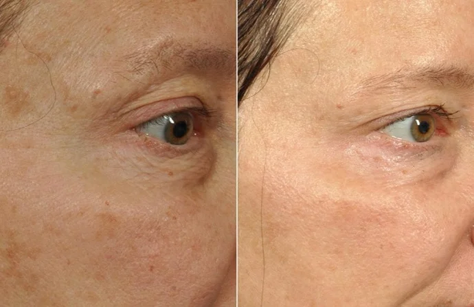 Microneedling Treatment before and after
