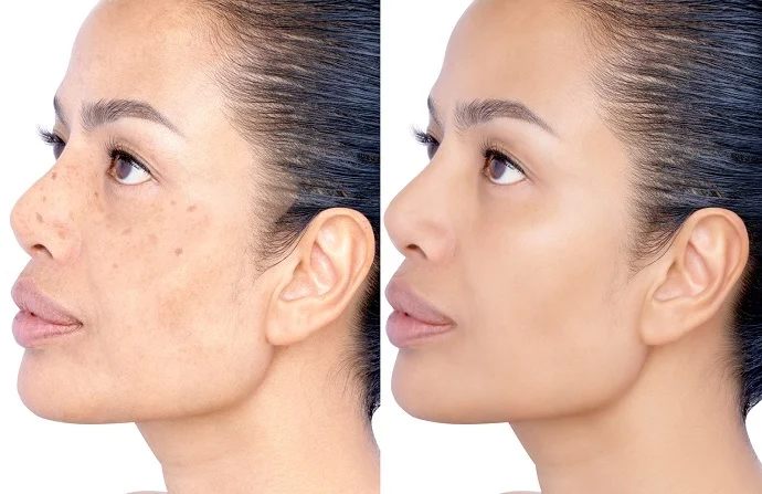 Microneedling Treatment before and after