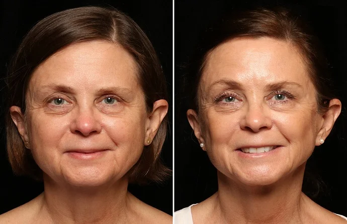 Non-Surgical Facelift before and after