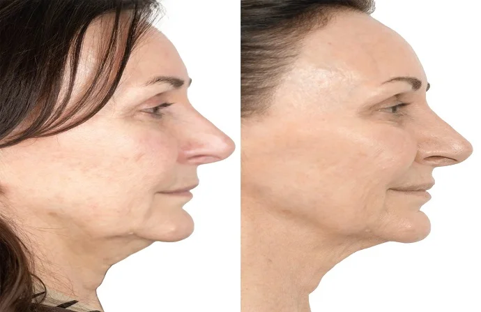 Non-Surgical Facelift before and after