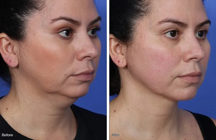 Non-Surgical Facelift before and after