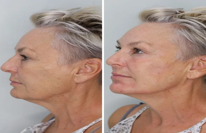 Non-Surgical Facelift before and after