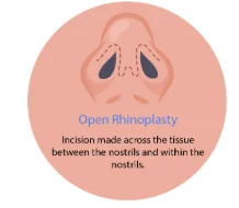 Open Rhinoplasty